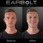 Earbolt - Ear Pinning Adhesives   Cosmetic Ear Correctors  pack Of 20 
