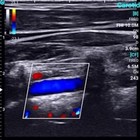Chison Sonoeye  P2 Linear Array Ultrasound For Android Color Doppler Vascular