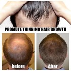 Beard And Hair Growth Derma Roller 0 5mm Titanium Derma Roller Usa Fast Shipping