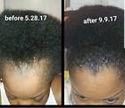 Fast Hair Growth Oil For Alopecia And Hair Loss W fenugreek  Shea Butter   Baoba