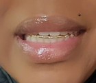 Retainer With Gold Trim  Affordable Keep Teeth From Shifting While Turning Heads