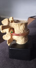  the Pinched Nerve  Chiropractic Subluxation Model With Led Lights