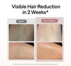 Ulike Air 10 Ipl Laser Hair Removal Painless Device With Ice-cooling Fda-cleared