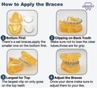 Temporary Tooth Decoration Fake Braces With Metal Wires Ortho Patient Education