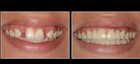 Retainer With Teeth  Affordable Way To Fill In Your Smile  With 1-3 Teeth Added 
