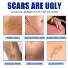 Pimple Scar And Acne Mark Spots Removal Gel Ointment Skin Care Blemish Cream Us