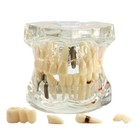 Dental Implant And Restoration Model Transparent Pathological Teeth Study Model