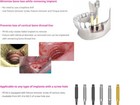 Neobiotech Fr Implant Fixture Remover Kit Removal Dental Screw Hex Driver Wrench