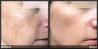 Lactic Acid Skin Peel 40    Healing Cream   Fan Brush - Professional Results 