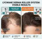 0 5mm Derma Roller 540 Titanium Microneedles Hair Growth With Scalp Massager