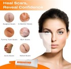 Strataderm Professional Scar Therapy Gel   Old And New Scars From General Surger