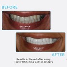 Teeth Whitening Gel Kit Strong Tooth Bleaching Kit With 5led Light Tray Pap