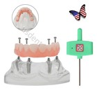 All On 4 Dental Implant Model Overdenture Upper Jaw 4 Implant Clear Detachable