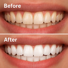 Teeth Whitening Gel Kit 5x Strong Tooth Bleaching Kit With Led Light Tray