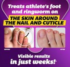 Silka Max Strength Foot Antifungal Liquid  New