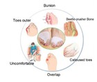 1 Pair Bunion Splint Big Toe Straightener Hallux Valgus Corrector Foot Support