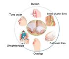 1   pair Bunion Splint Big Toe Straightener Corrector     Hallux Valgus Pain Relief