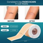 Scar Removal Silicone Scar Tape For Hypertrophic Scars   Keloids  1 6   X 150 
