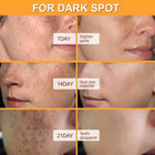 Whitening Freckles Face Cream Removal Melasma Dark Spots Corrector Lighten Melan