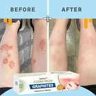 Psoriasis Ointment Skin Treatment 25gm New