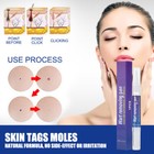1-10x Skin Tag Remover Pen Skin Tag Mole Wart Dark Spot Remover Painless   Safe