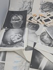 Vintage Medical Clinical Oncology Photos  Tumors  Cancer  Surgery