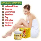 Health Care Psoriasis Cream Eczema Ointment Scalp Psoriasis 3 Bottle Combo