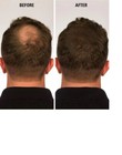 5 Box Caboki Hair Building Fiber Bold Thinning Natural Black Dark Brown 25 Grams