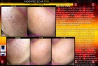 Best Treatment For Indented Scars Acne Chicken Pox Pitted Scar Removal Peel