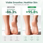 Urea Cream 40 Percent For Feet Maximum Strength  Foot Cream For Dry Cracked Heel