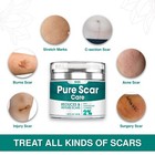 Scar Removal Advanced Cream Treatment Gel For Surgical Scars  Acne Scars  C-sect