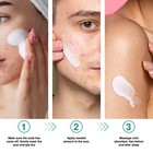 Scar Removal Advanced Cream Treatment Gel For Surgical Scars  Acne Scars  C-sect
