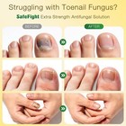 Toenail Fungus Treatment Extra Strength 25  Undecylenic Acid - Nail Repair