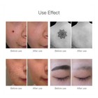Red Light Picosecond Laser Tattoo Removal Pen Skin Dark Spot Remover Tool