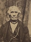 Elderly African American Man W  Clubbed Hand 1860s Cdv Carte De Visite Photo